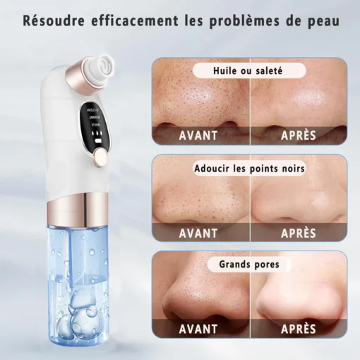 Aspirateur de points noirs, soin visage – Image 5
